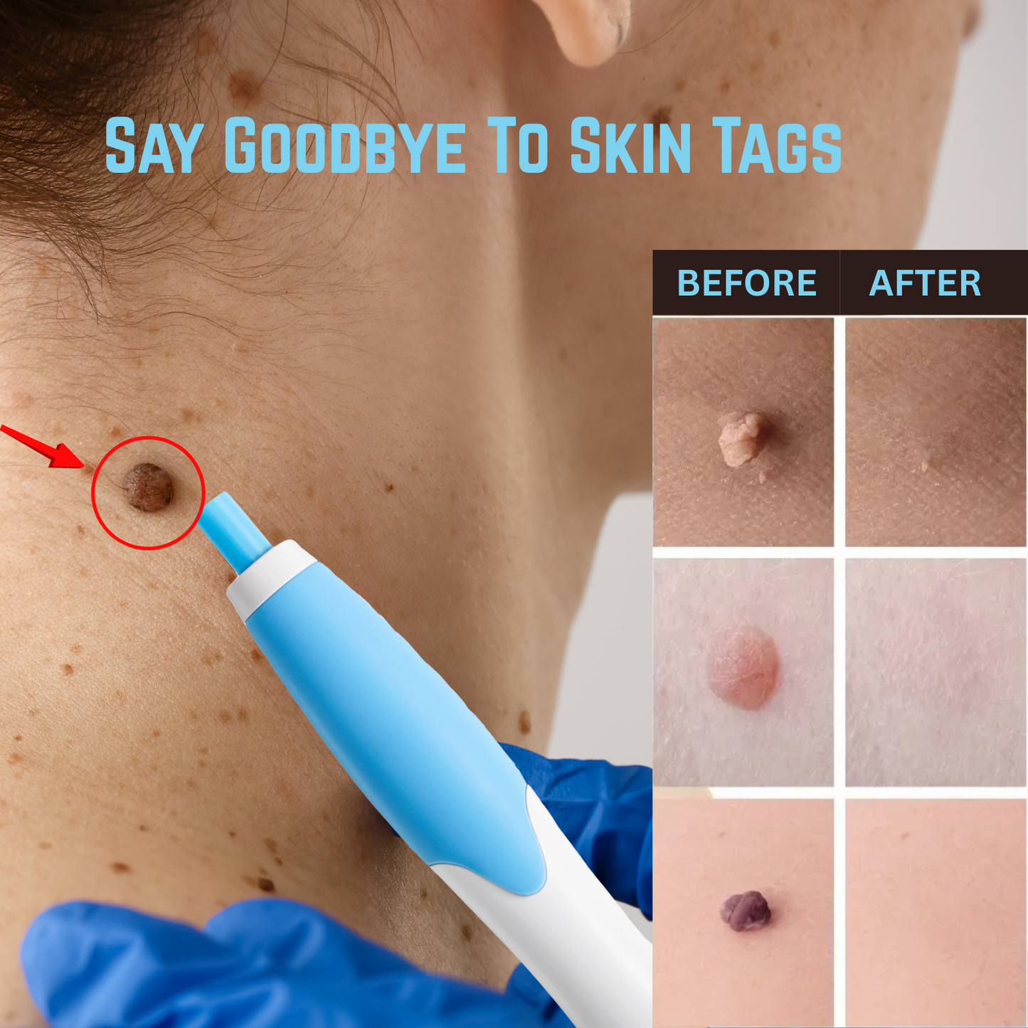 TagZap- Skin Tag Removal Kit