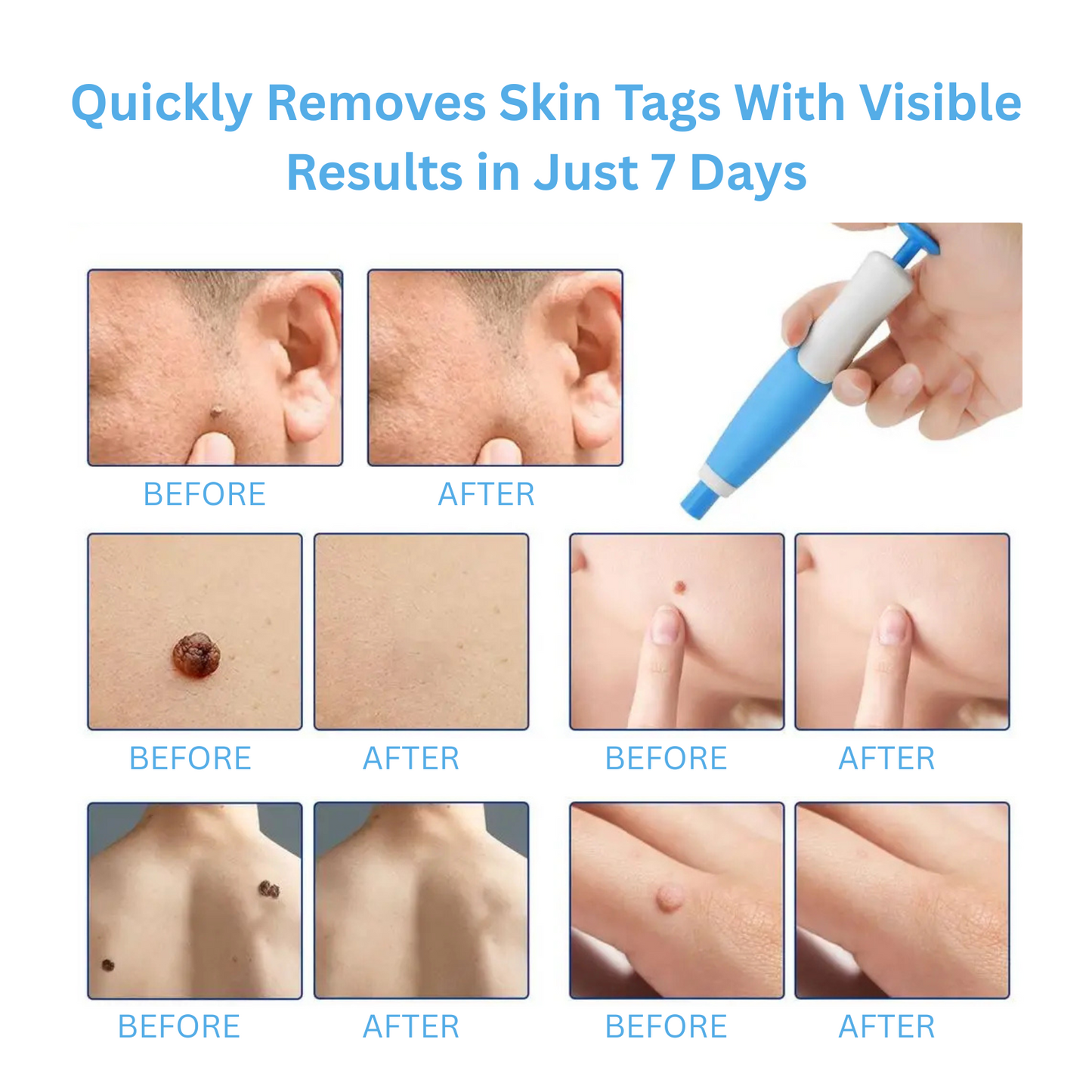 TagZap- Skin Tag Removal Kit